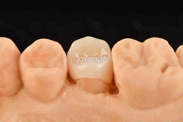 Buy cheap Customizable White Composite Inlay Onlay Natural Looking Minimally Invasive Tooth Restoration from wholesalers