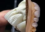 Natural Looking Zirconia Tooth Crown Stain Resistance All Zirconia Crown