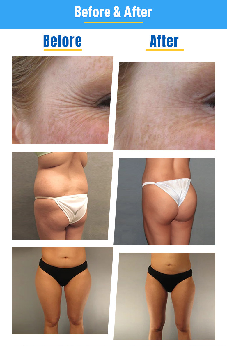 Portable RF Vacuum Cavitation Machine 6 Handles Body Slimming Lipo Laser 80K