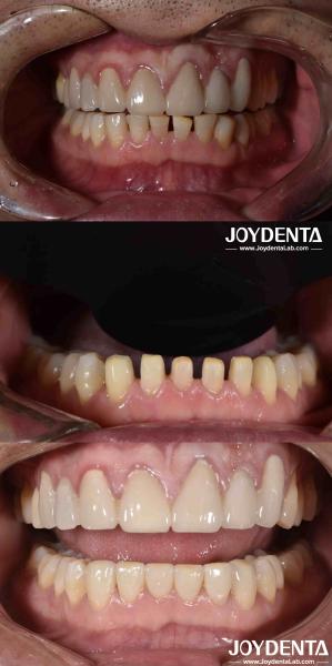 Nature Shape Cosmetic Dentistry Porcelain Veneers , Dental Cosmetic Porcelain