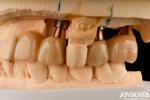 Restoration Of Missing Teeth Implant Crown and Bridge Safe For Oral with