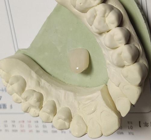 Buy cheap Resin Natural Colour Composite Temporary Crown For Anterior Teeth from wholesalers