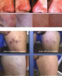 RBS vascular spider vein removal machine