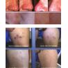Buy cheap effective fat granules removal with obvious results from wholesalers