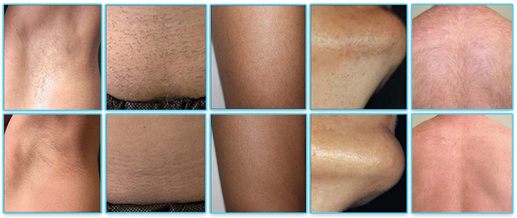 Portatil Long Pulse Laser Hair Removal Equipment Direct Coupling