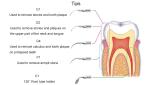 Autoclavable Dental Ultrasonic Scaler Medical Portable Piezo Electric Scaler
