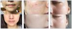Opt Hair Removal Ipl Machine Face Acne Treatment Wrink Skin Rejuvenation Acne