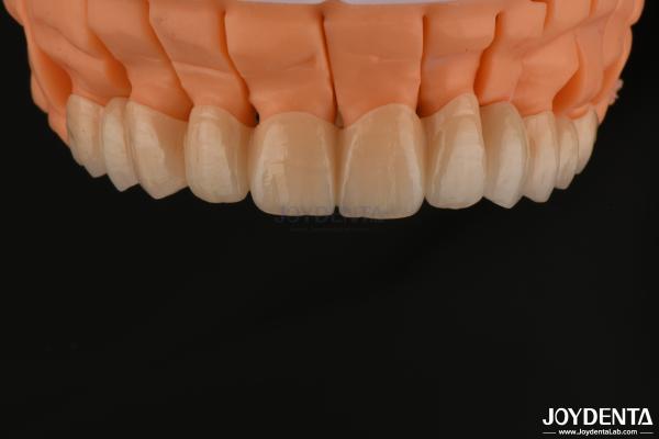 High Aesthetics Layered Zirconia Single Crowns Bridges Implant for Dental