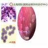 Buy cheap Clear Genital warts removal condyloma treatment herbal product for male sexually transmitted diseases from wholesalers