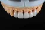 China Dental Lab Laminate Dental E-Max Veneer Self Adhesive