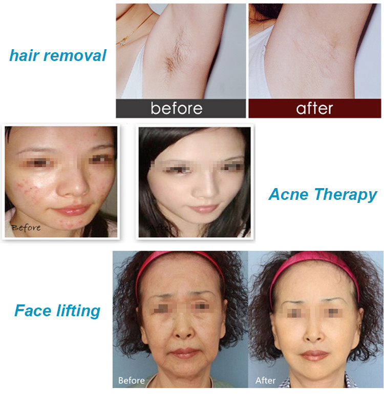 Hair Removal Beauty Parlour Products Painless Opt Ipl Shr Skin Rejuvenation Device