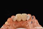 Multilayer PMMA Polymethyl Methacrylate For Dental Restorations