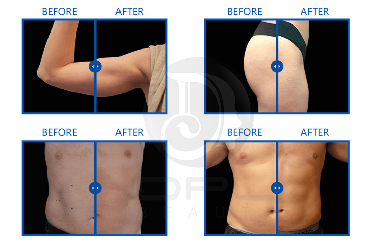EMT18 Body Contouring EMS Body Sculpting Machine , 2 In 1 4D Vacuum Roller Machine