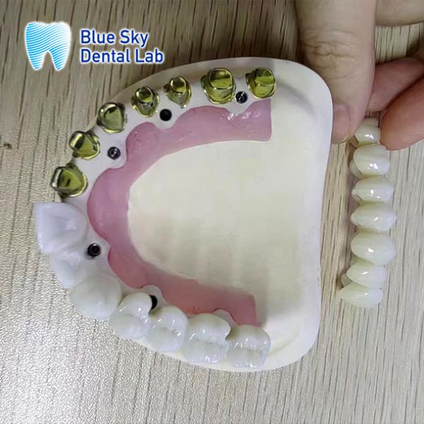 Buy cheap Silver Gold Pure Titanium Metal Frame Dental Gold Plated Metal Frame Partial from wholesalers