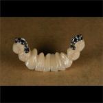 Aesthetic Partial Denture Precision Attachments Medical Grade OEM