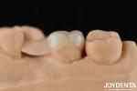 High Strength Zirconia Dental Inlays And Onlays For Tooth Restoration