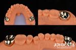Dental Restoration Gold Metal Crowns for Oral Rehabilitation Treatment