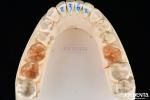 Customizable Shape Composite Inlays And Onlays Dental Stain Resistance Long