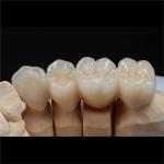 Personalized Strong Ceramic Zirconia Dental Crown Full Mouth Full Contour