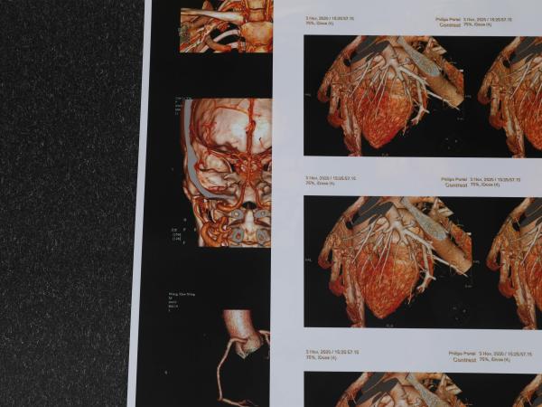 Buy cheap 240gsm 180 Micron Medical Inkjet Film 3D CT Chest Film Environmental Friendly from wholesalers