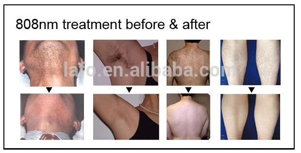 Portable CE approved 808nm laser medical machine diode hair removal laser machine price