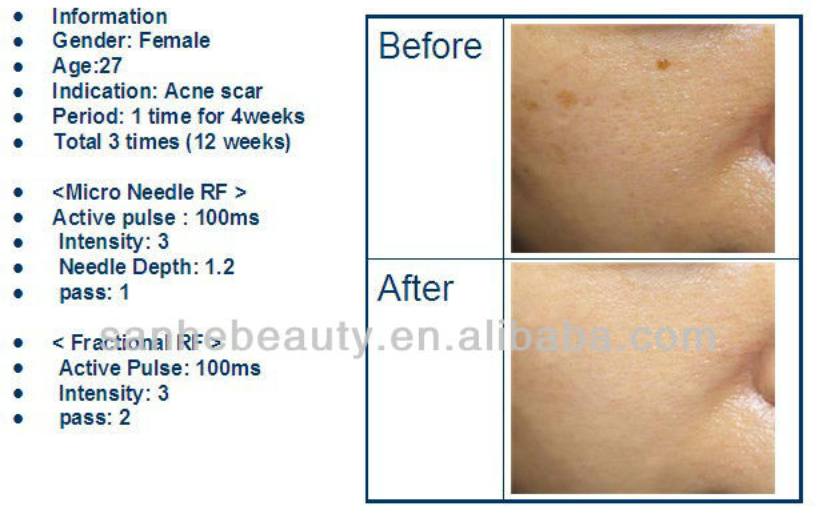 25 pins and 49 pin fractional micro needling rf fractional rf microneedle pantip