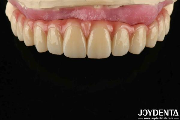 Buy cheap Comfortable Wear Titanium Malong Hybrid Bridge Dental Adjustable Design Light Weight from wholesalers