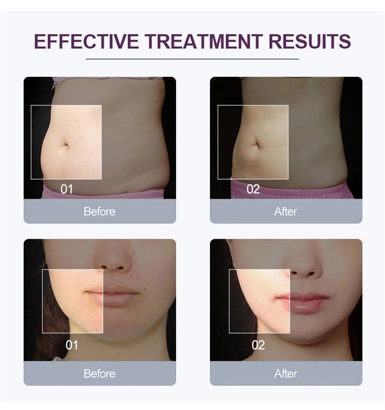 40k Ultrasonic Cavitation Cellulite Removal Fat Burner Weight Loss Body Shape Slimming Machine