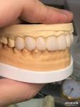 16 Shades Color Emax Dental Veneers A1-A4 High Stain Resistance For Perfectly