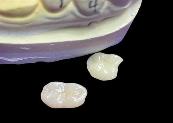 Buy cheap IPS e.max Ceramic Inlays and Onlays for Molar Restoration Natural Aesthetic and Superior Durability for Long-Lasting Results from wholesalers