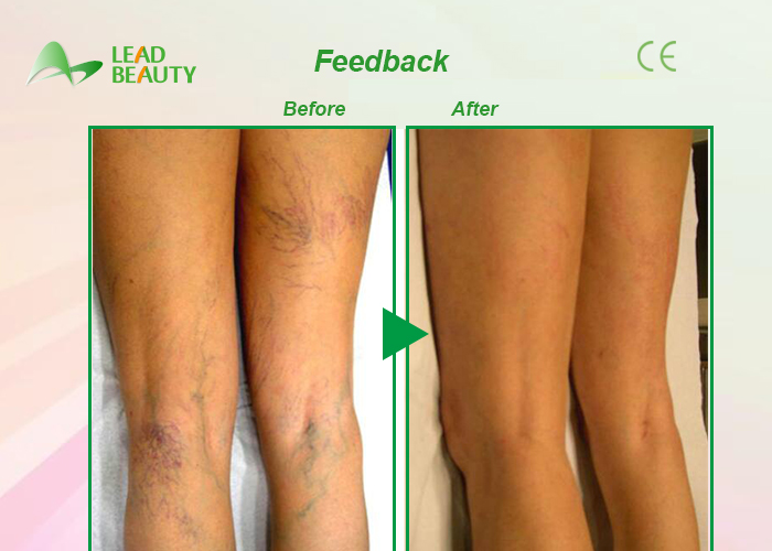 30Mhz spider vein removal machine laser varicose vein removal treatment