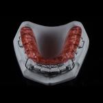 Mouth Orthodontic Expanders Adults Plate For Dental Alignment