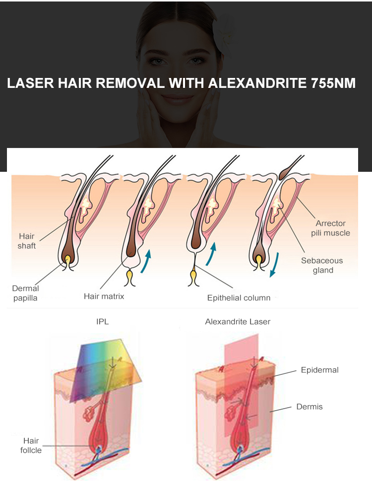Hair Removal Alexandrite Laser Machine