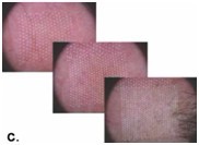 Radiofrequency RF CO2 Fractional Laser Beauty Equipment System ODM
