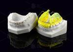 Acrylic Orthodontic Bionator Appliance Corrects Class II Malocclusion