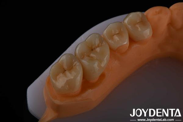 Buy cheap High Aesthetics Full Contour Zirconia For Crowns Bridges Implants Dental Restorations from wholesalers