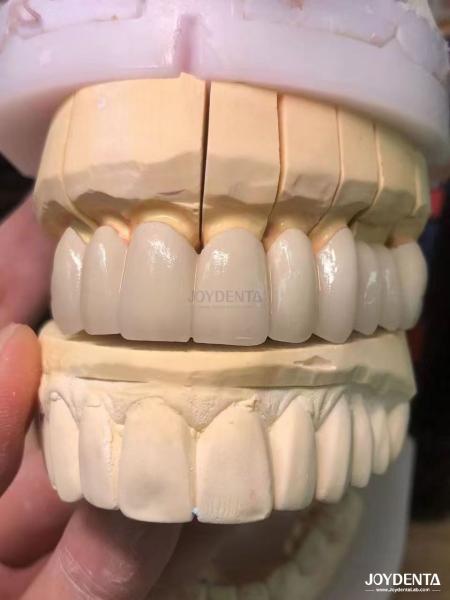 Buy cheap Precision Fit Porcelain Fused to Metal PFM Crowns Seamless Natural Smile Enhancement from wholesalers