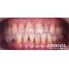 Buy cheap Customizable Dental Maryland Resin Bonded Bridges for Anterior And Premolar Teeth from wholesalers