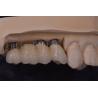 Buy cheap Precision Fit Dental Implant Crowns Titanium / Zirconia / PFM Restoring Missing Teeth from wholesalers
