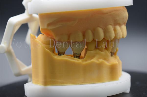 Buy cheap Precision Titanium Dental Crown For Tooth Implant Easy To Clean And Maintain from wholesalers