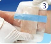 Hydrocolloid Foam Dressing , Alginate Hydrocolloid Dressing For Pressure Ulcers