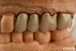 Premium Gold and Palladium Alloy Dental Crowns for Enhanced Durability