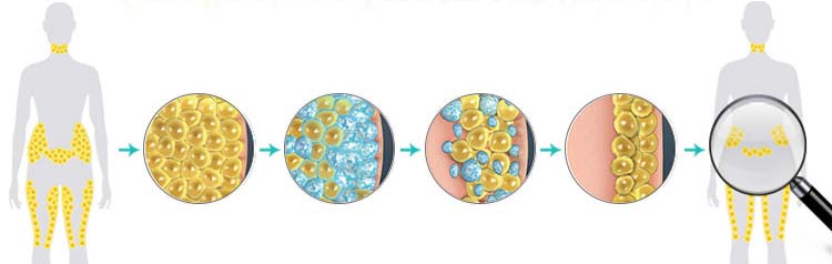 Nubway quick freeze cryo cool body shaping contouring cryolipolysis fat freeze slimming machine