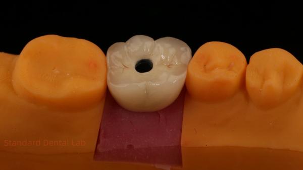 Buy cheap Screw Retained PFZ Porcelain Layered Zirconia Dental Implant Crown from Dental Lab ISO FDA CE Certified with 5-Year Guarantee from wholesalers