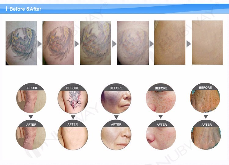 1064nm/532nm laser Q switched professional sapphire ruby laser tattoo removal machine