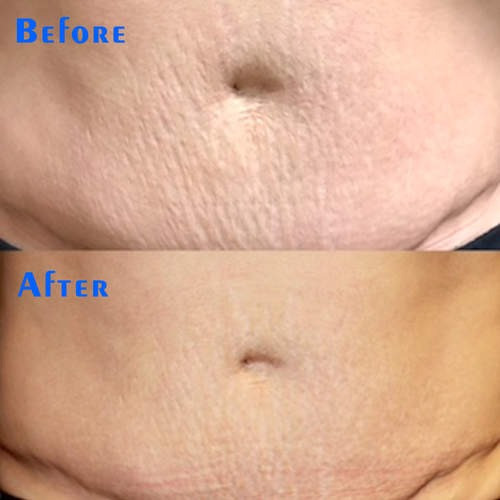 240V 60HZ Micro Needle Fractional RF Machine Wrinkle Remover Skin Rejuvenation