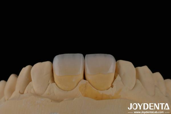 Buy cheap Long Lasting Dental Feldspathic Veneer Natural Tooth Color Translucent Appearance from wholesalers