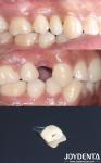 All On 4 Dental Tooth Implant Cylindrical Shape Titan Implant Dental Rough