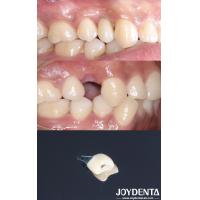 Buy cheap All On 4 Dental Tooth Implant Cylindrical Shape Titan Implant Dental Rough product