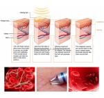 Home Use Laser Tattoo Removal Machine Therapy Device Fungal Remover Onychomycosi